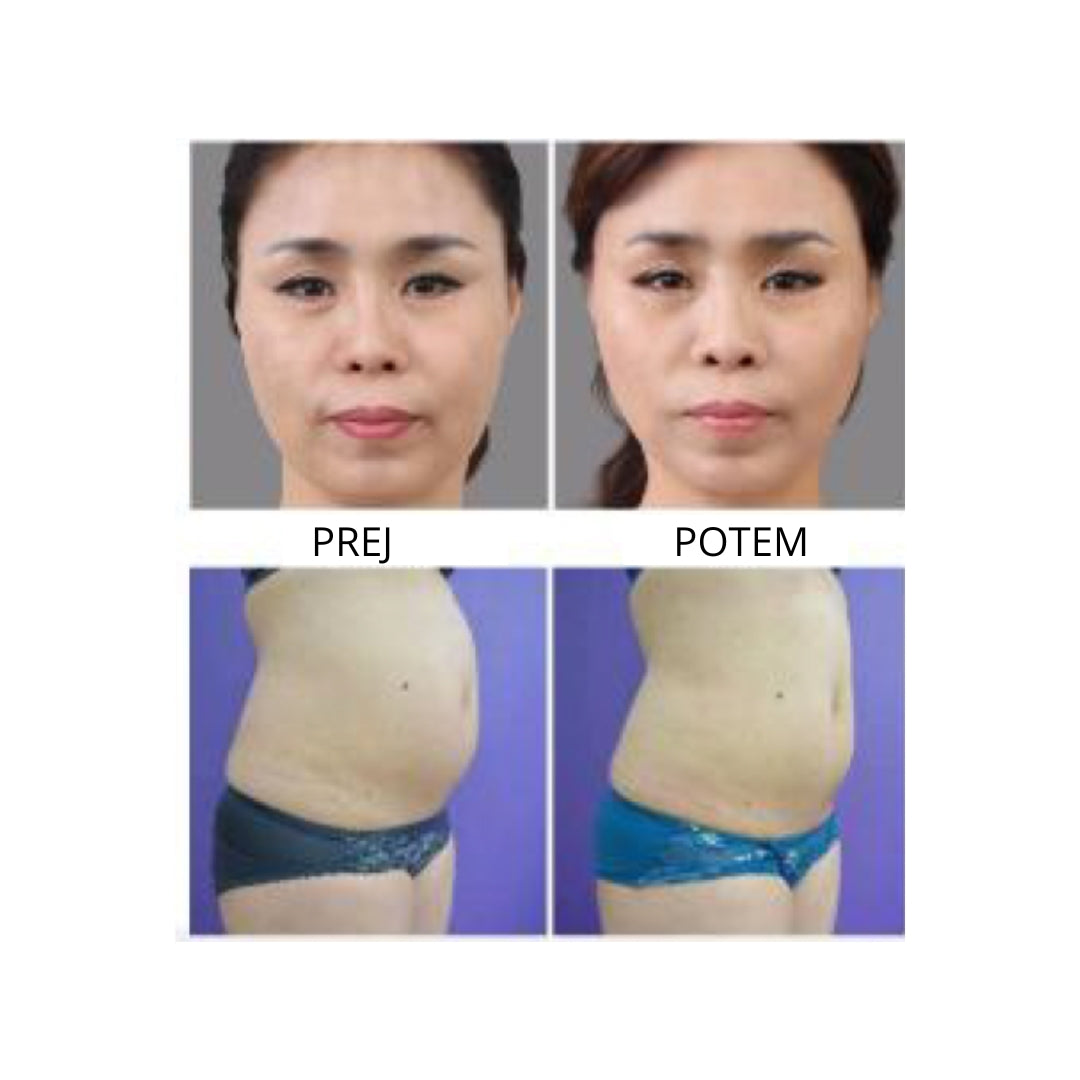 Mini hifu naprava 6v1