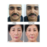 Mini hifu naprava 6v1