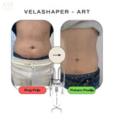 VelaShaper ART II - najem s samočistilno funkcijo