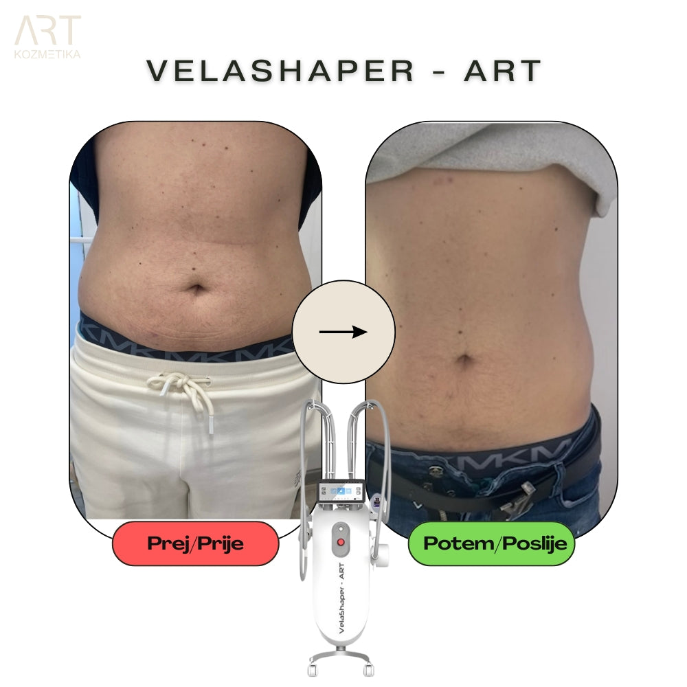VelaShaper ART II - najem s samočistilno funkcijo