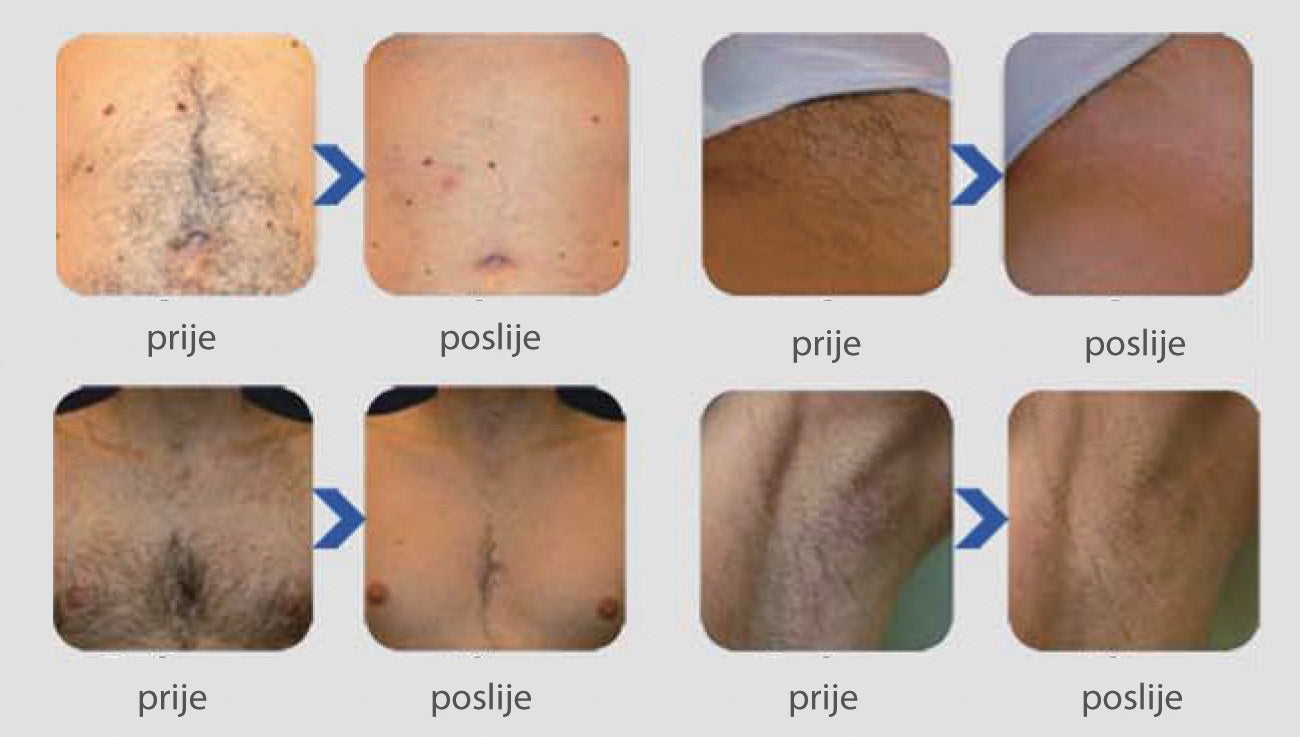 eLite Ana SHR IPL+RF