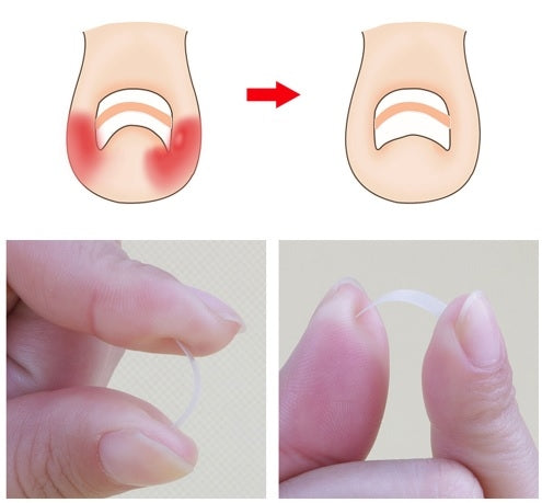 Sponke za vraščene nohte 10/1