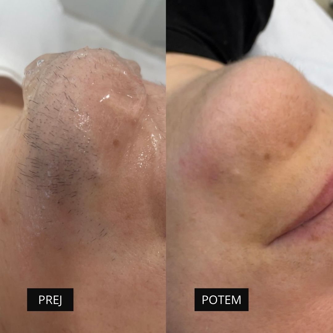 Diodni laser TrisCAM I.C.E